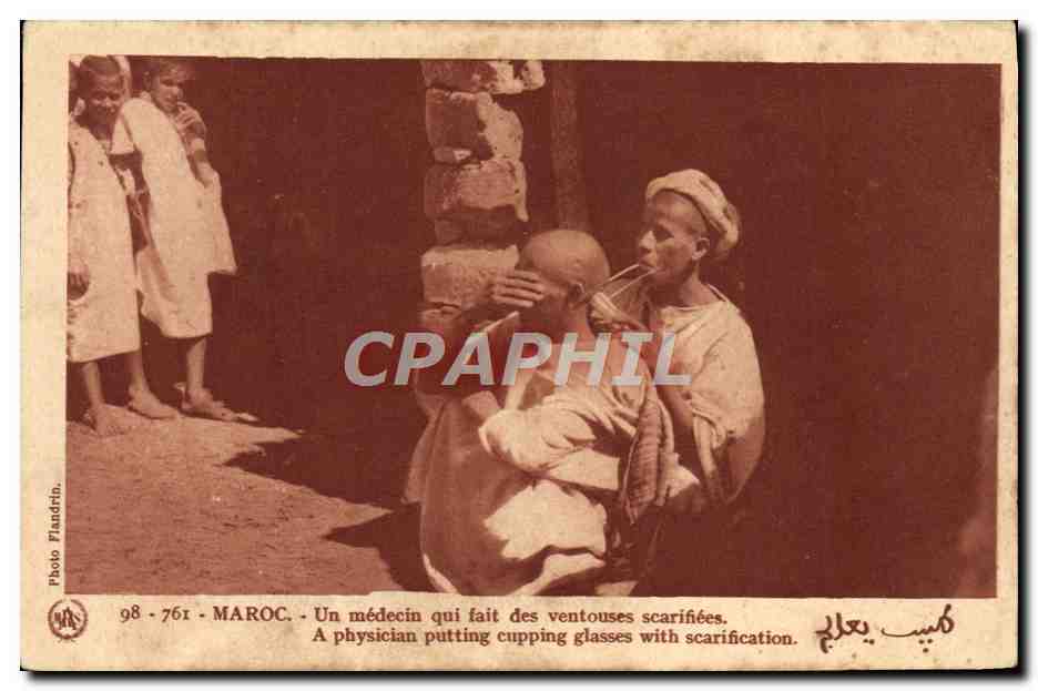 CPA Maroc un medecin qui fait des ventouses scarifiees 