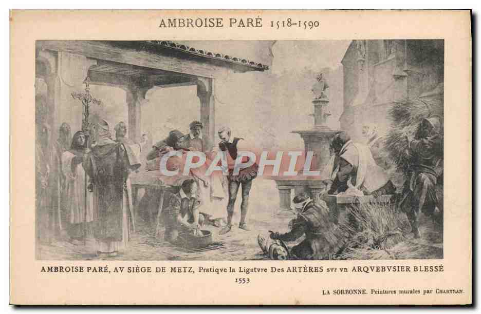Ambroise Paré — Pratique de la ligature sur un arquebusier blessé au siège de Metz — Peintures murales par Charttan