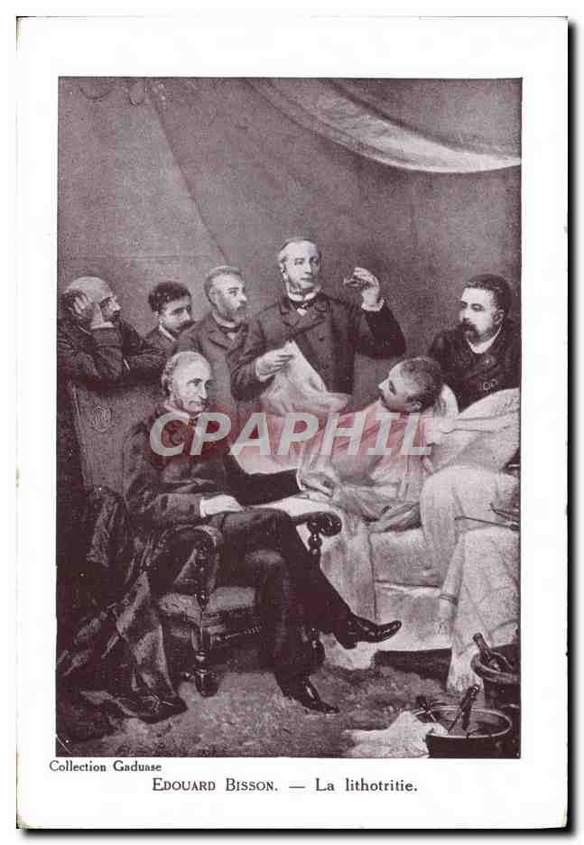 CPA Edouard Bisson La lithotritie