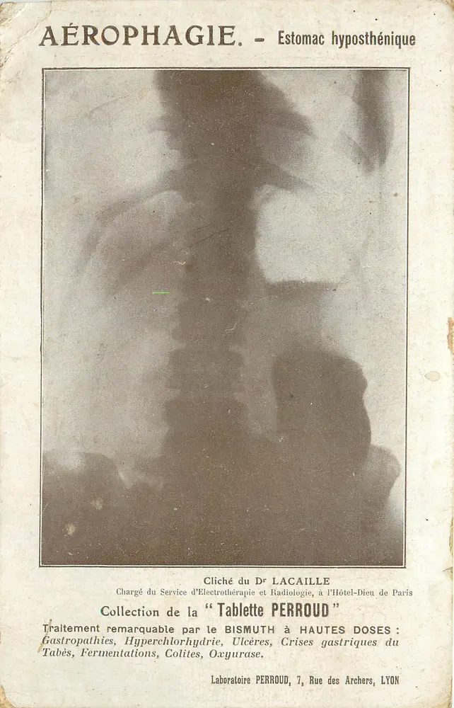 Aérophagie - Estomac hyposthénique — Cliché du Dr Lacaille, Collection de la 'Tablette Perroud', Laboratoire Perroud, Lyon - Recto